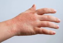 Reporta SSH 144 casos activos de virus Coxsackie