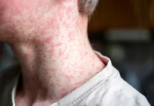 Reforzaran vacunación ante aumento de sarampión en México