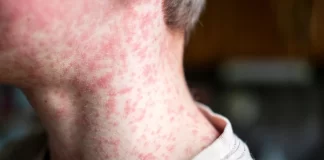 Reforzaran vacunación ante aumento de sarampión en México