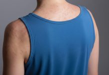 Confirman 16 casos de sarampión en Puebla