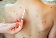 Muere menor poblano por sarampión en Tlaxcala; no tenía esquema de vacunación