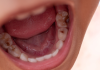Tlaxcala es el tercer estado que registra más casos de caries en niños