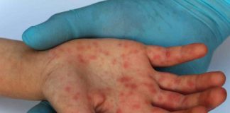 México supera los 3 mil contagios de sarampión; van 9 muertes