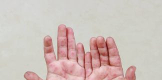 Síntomas y prevención del virus coxsackie en México Síntomas y prevención del virus coxsackie en México