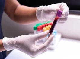 México registra 15 mil 480 nuevos casos de VIH en 2025