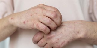 Reportan 13 nuevos casos de sarampión en Morelos; México supera los 5 mil contagios