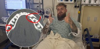 Jake Paul sufrió doble fractura de mandíbula tras caer ante Anthony Joshua