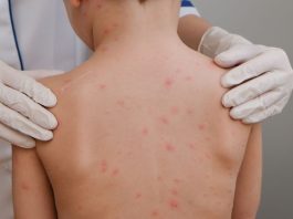 Se registran 24 muertes y más de 5,700 casos de sarampión en el país