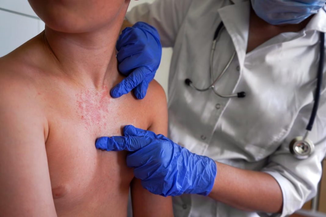 Chiapas exhorta a cancelar eventos masivos por brote de sarampión