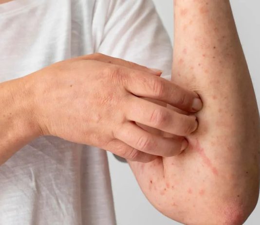 Sarampión se ha extendido por todo México con más de 7 mil casos confirmados y 24 muertes