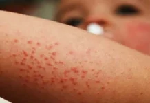 Jalisco y Chiapas concentran la mayoría de casos de sarampión en México