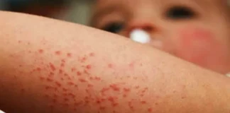 Jalisco y Chiapas concentran la mayoría de casos de sarampión en México