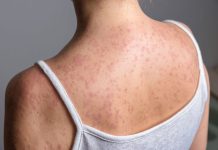 Se reporta más de 9 mil casos de sarampión en México y 28 defunciones en siete estados