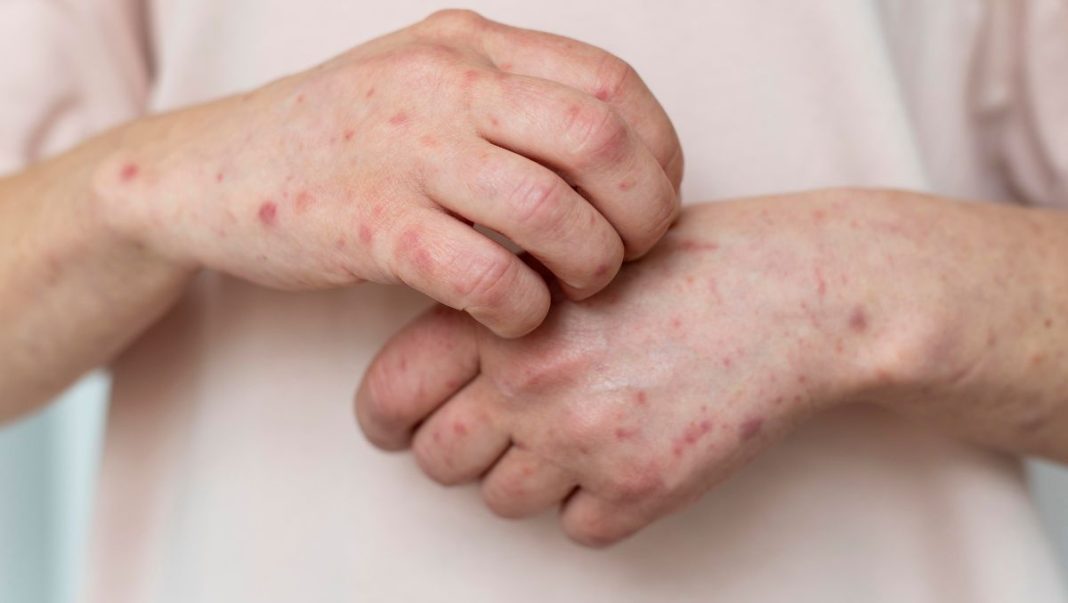 México registra 31 muertes por sarampión en nueve estados