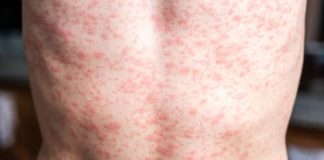 Brote de sarampión en México deja 28 muertes y más de 8,800 casos confirmados Brote de sarampión en México deja 28 muertes y más de 8,800 casos confirmados