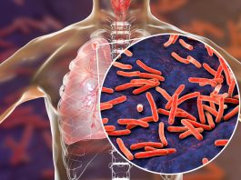 Aumentan los casos de tuberculosis respiratoria en México durante 2026